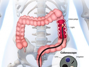 colonoscopy s1 what is colonoscopy illustration