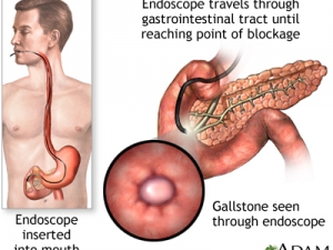 ercp